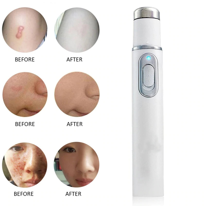 You Are Magnifique - Stylo de luminothérapie anti acne